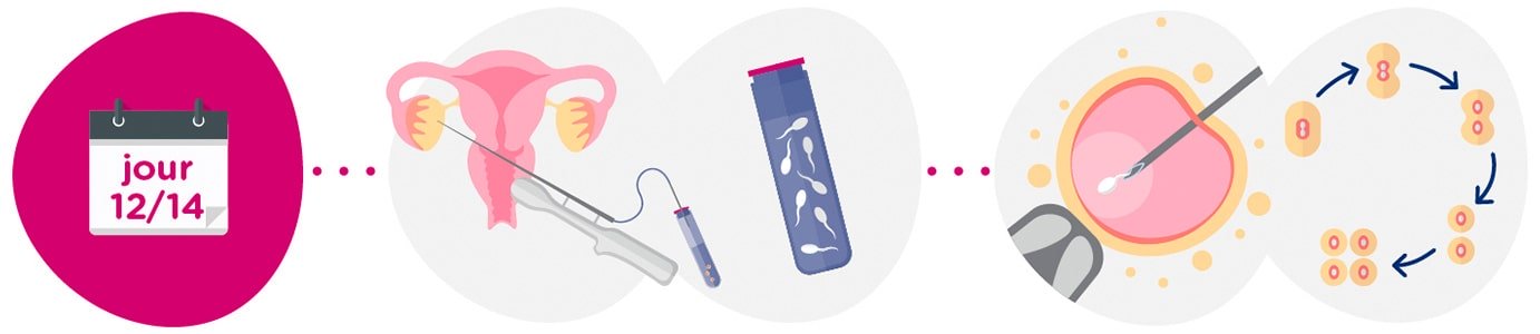 Recueil des ovocytes + échantillon de sperme